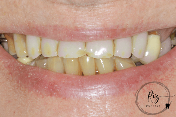 1c_portrait_cropped smile_preop.png