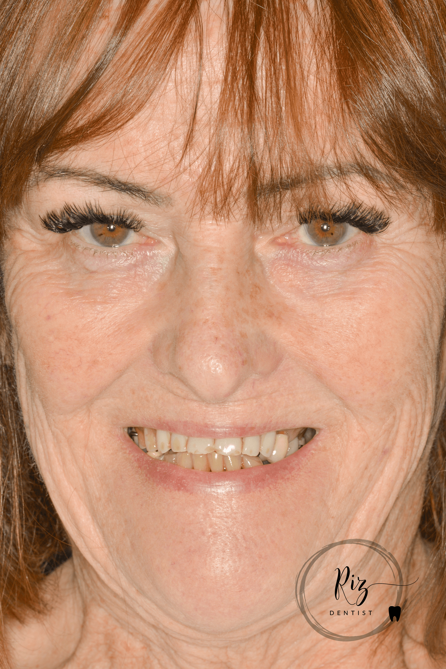 1a_portrait_full_preop.png