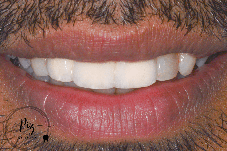 Extraction to Restore 3 Front Teeth!!