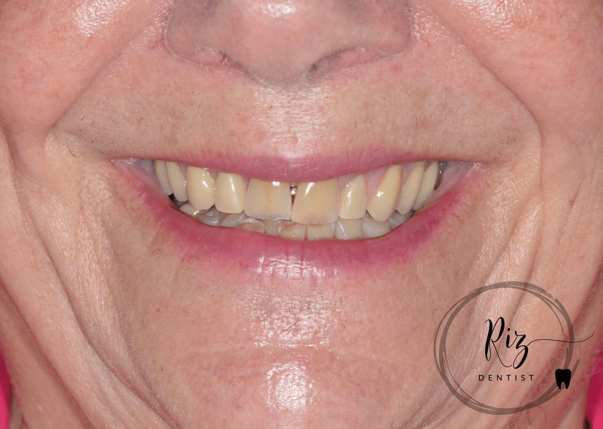 Enhancing a Denture's Aesthetics