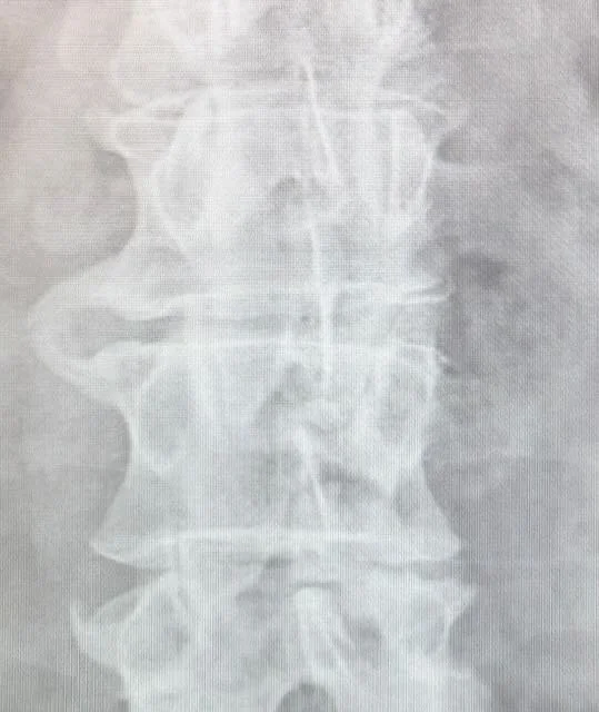 Bone Spurs