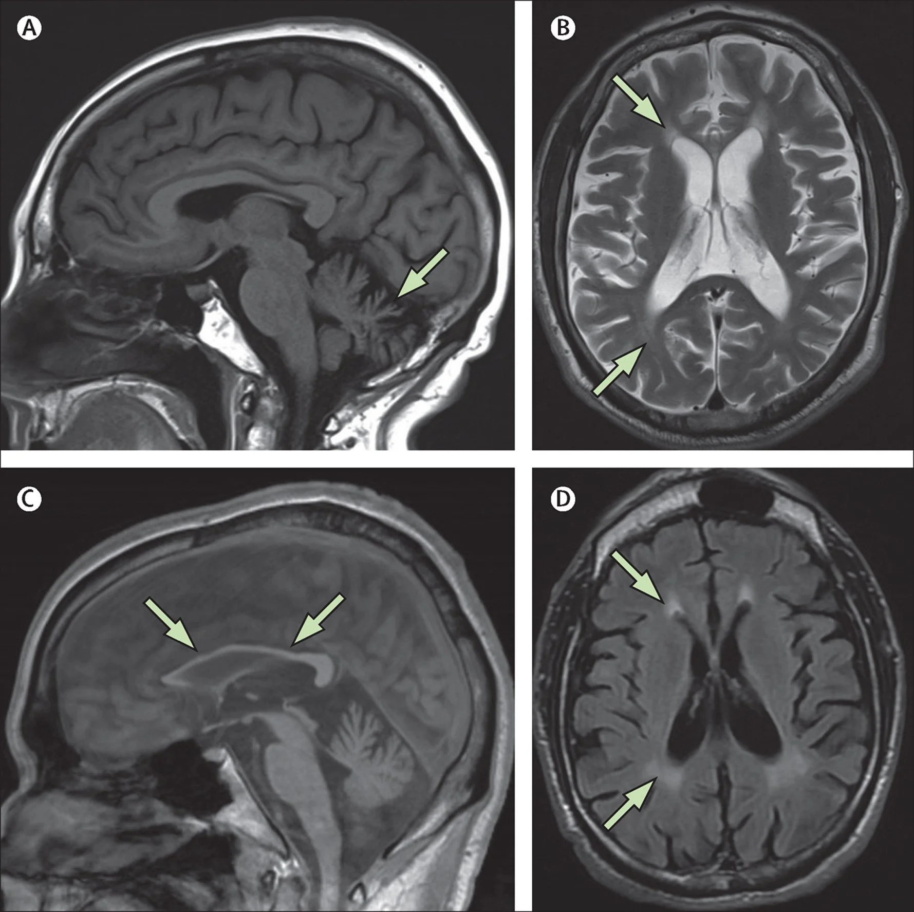 A Modern Approach to Hereditary Spastic Paraplegia
