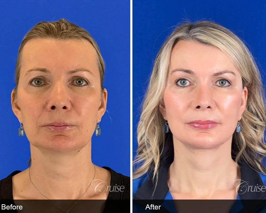 Left (Before) &amp; Right (After)