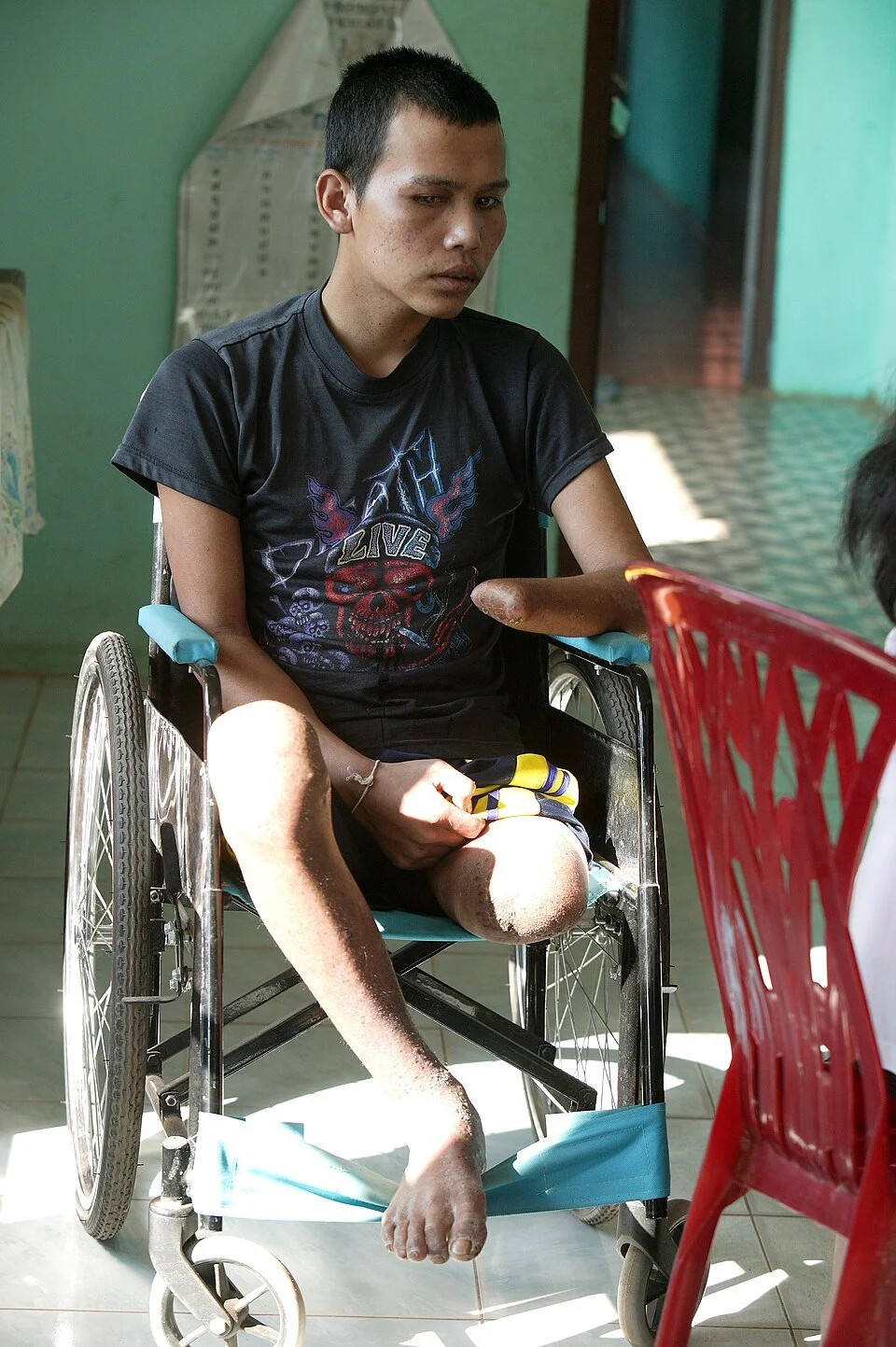 Laomn, an 18-year-old Laotian landmine victim. Jim Holmes. CC BY 4.0.