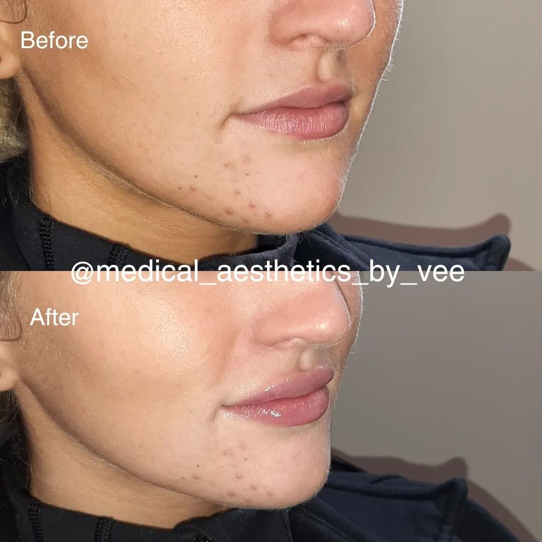 This beautiful client came in for a mini lip plump to help add more volume to her upper lips and that's what was achieved. 
Note: the after pictures have swelling and some bruising. Full results will be seen at 2 weeks. 
Loving her results and that s