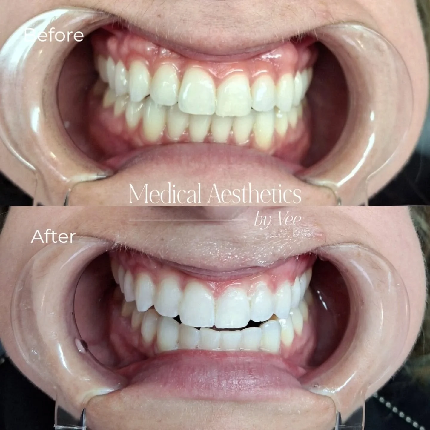 ✨ Holiday-Ready Smiles Start Here! ✨
There&rsquo;s no better time than the holiday season to brighten your smile! Cosmetic Teeth Whitening is a quick, effective way to lift deep staining and boost your confidence just in time for photos, parties, and