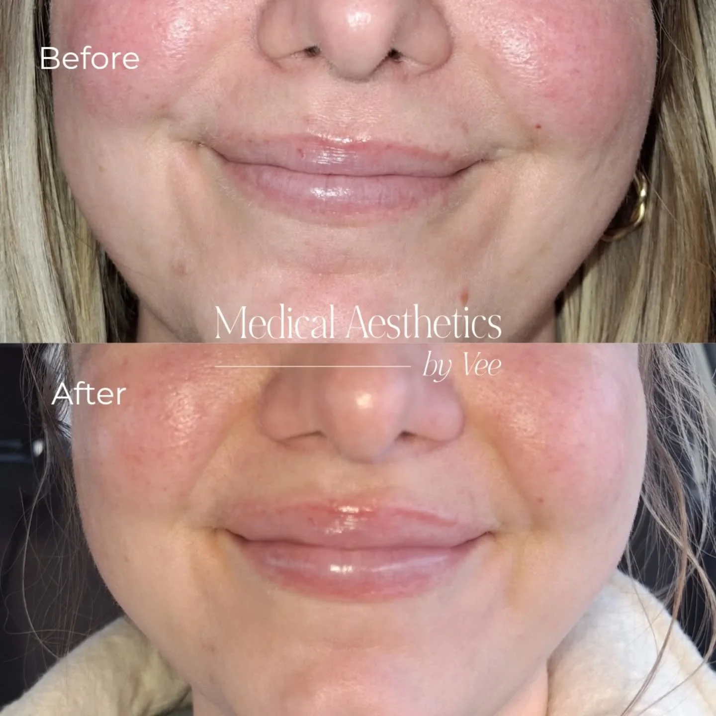 ✨ My Personal Lip Flip Experience ✨

I do enjoy having a slightly fuller top lip, and I love a natural, subtle look &mdash; just a little more lift and definition. That&rsquo;s why a lip flip is my go-to. 💋

A lip flip works by placing a small amoun