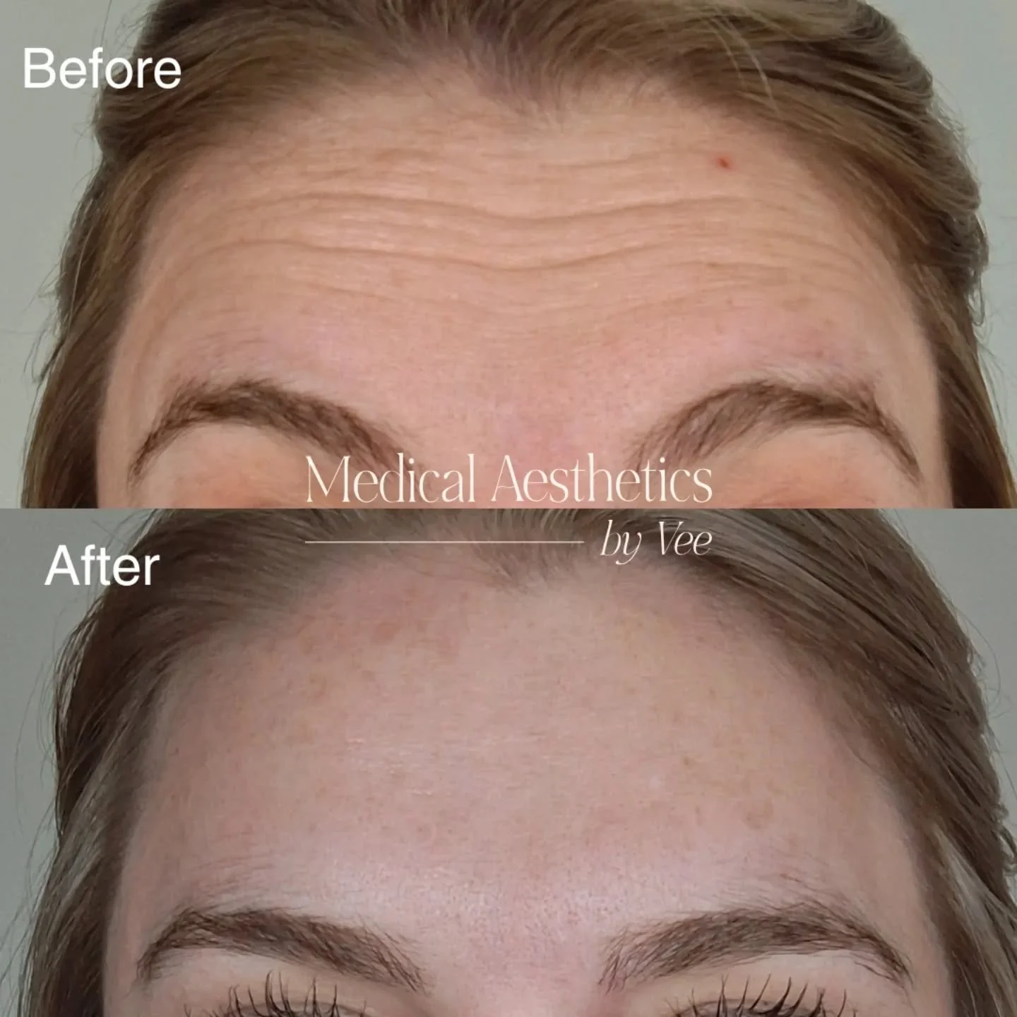 Real results. Real consistency. 💉✨

These are my own Dysport results (I'm 4 weeks away from turning 37), and I&rsquo;m always happy to share because this is exactly why I believe in it. Over time, Dysport has beautifully smoothed my forehead lines a