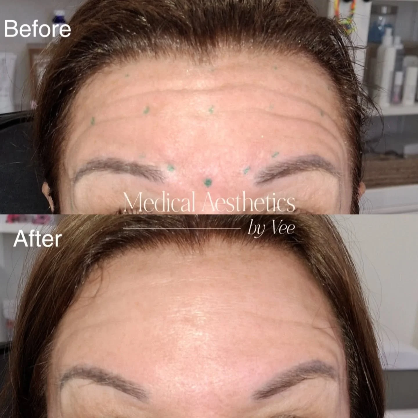 Botox isn&rsquo;t about erasing who you are 🤍
It&rsquo;s about softening frown lines and forehead wrinkles so you still look like you&mdash;just more rested, refreshed, and confident.

My approach is always subtle and age-appropriate: Smooth, not st