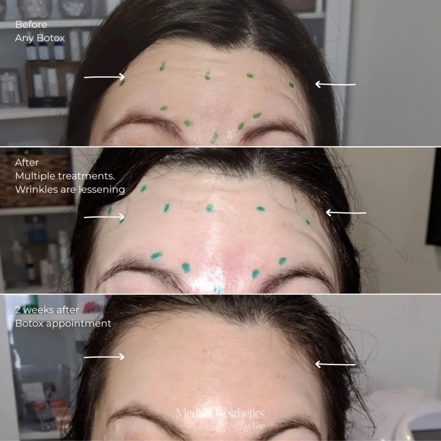 ✨ Consistency is KEY ✨

Preventative Botox isn&rsquo;t about freezing your face &mdash; it&rsquo;s about training the muscles and softening movement over time.

This client has been consistent with her treatments, and you can clearly see the differen