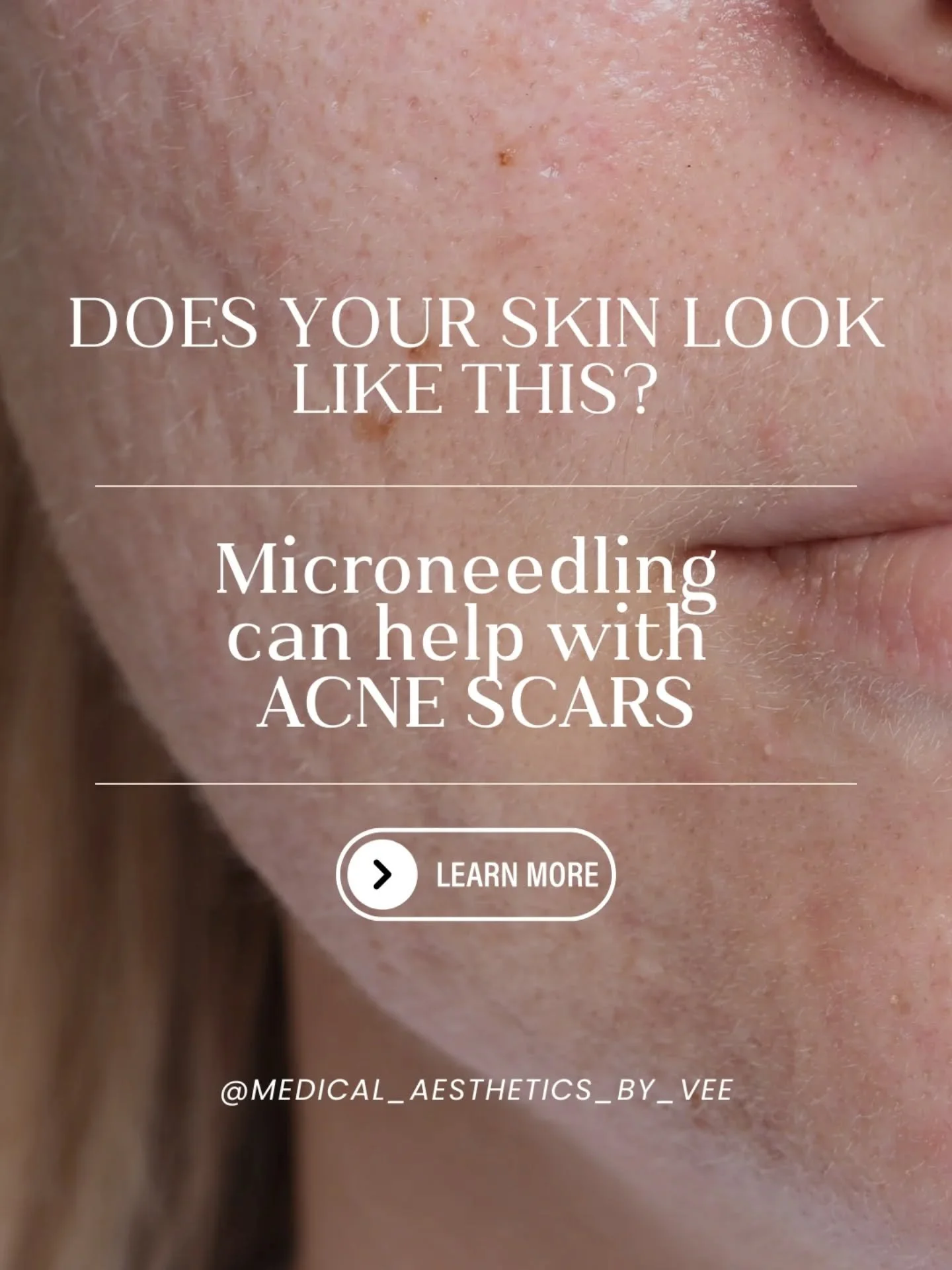 ✨️Acne scars don&rsquo;t have to be permanent!!✨️

Microneedling works by stimulating your skin&rsquo;s natural collagen production, helping to smooth texture, soften acne scars, and improve overall skin tone. Winter is the ideal time to start correc