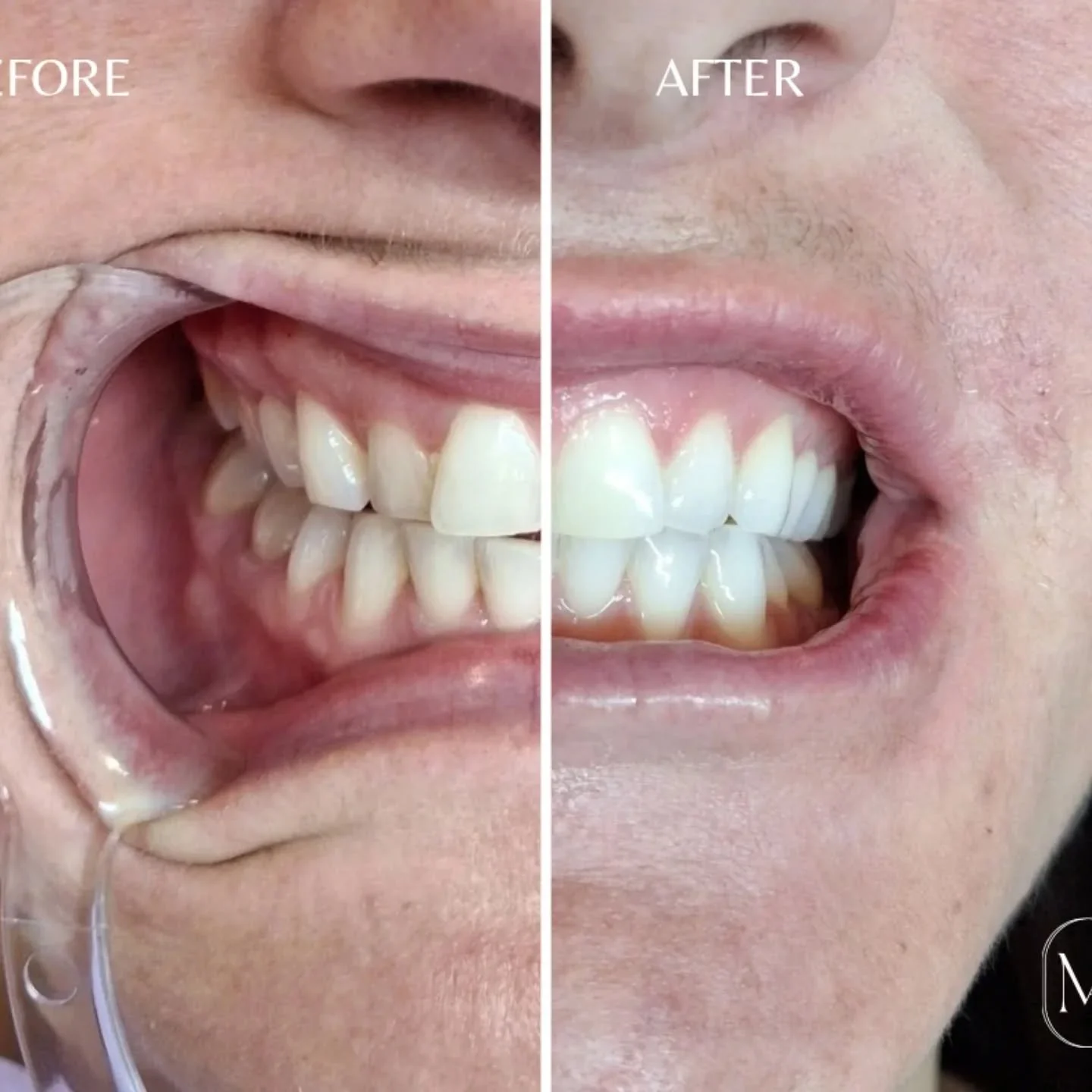 This client came to me with concerns about staining over time from coffee and other everyday consumables. In just one session, we were able to brighten her smile by 6 shades!

While some clients may need multiple sessions to reach their desired level