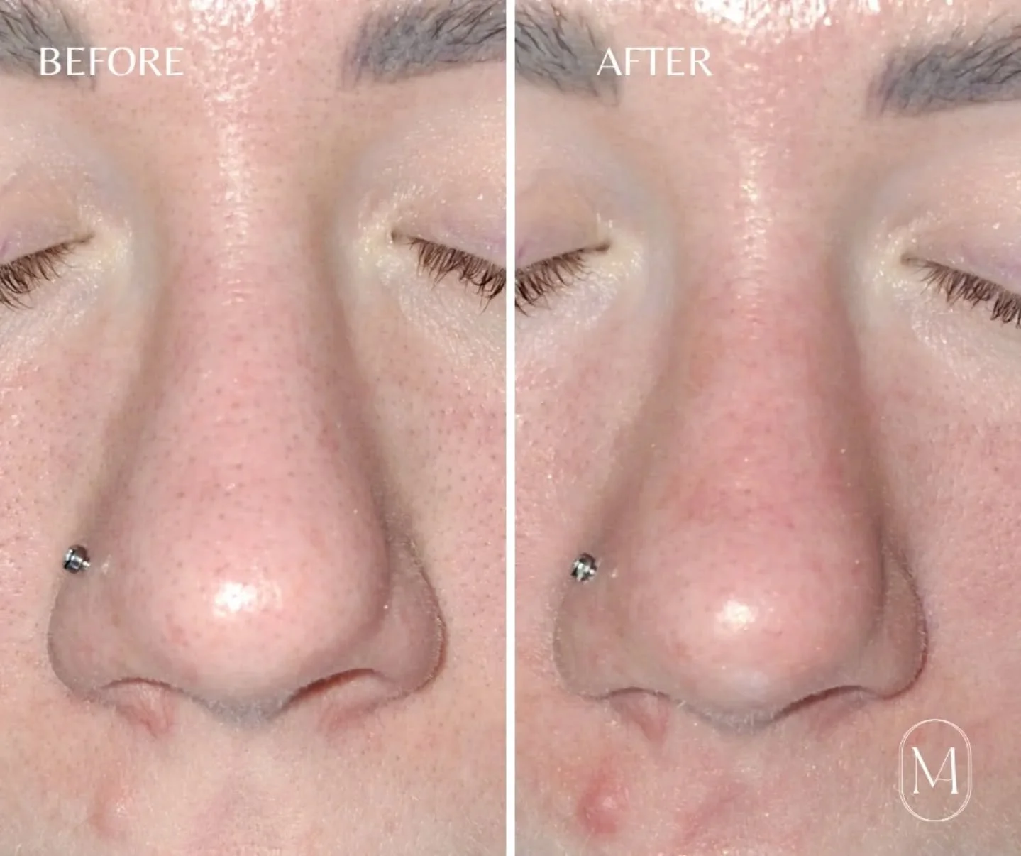 Seasonal changes can leave your skin feeling dull, dry, and just a little off!

That&rsquo;s your sign it&rsquo;s time for a refresh!

An advanced facial peel (aka a chemical peel) is a non-invasive way to gently exfoliate, restore balance, and bring