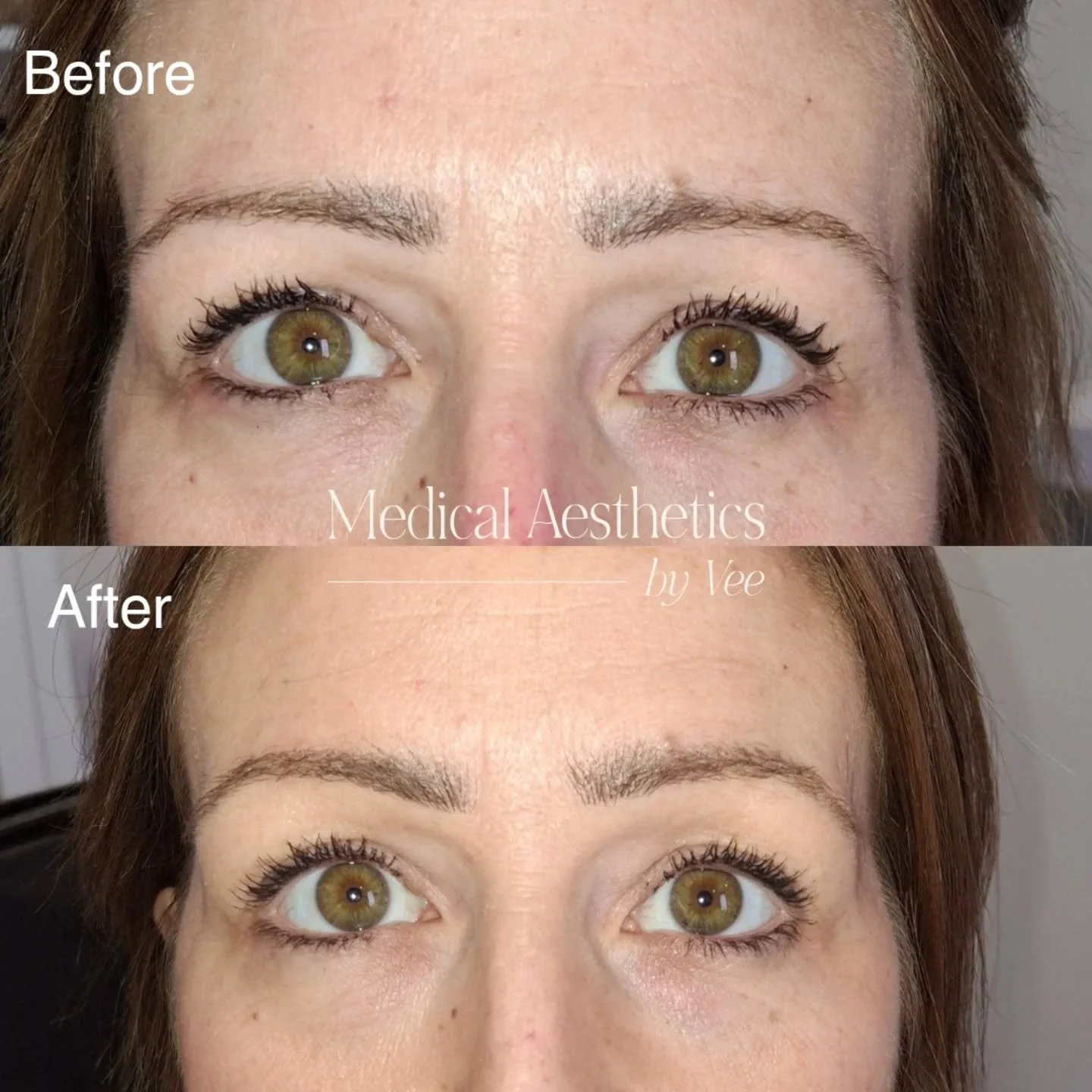 The power of a subtle brow lift!

A Botox brow lift is one of my favourite treatments for creating a refreshed, more awake look&mdash;without surgery. 

By gently relaxing specific muscles, we can lift the brows ever so slightly, helping to open up t