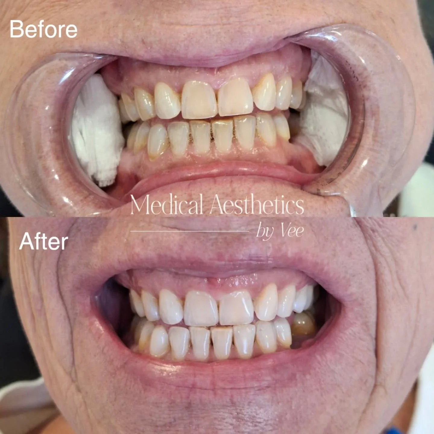 Say goodbye to years of staining and hello to a brighter, more confident smile!

Cosmetic Teeth Whitening is a simple, non-invasive treatment that can lift stains caused by coffee, tea, wine, smoking and everyday life&mdash;helping you look refreshed