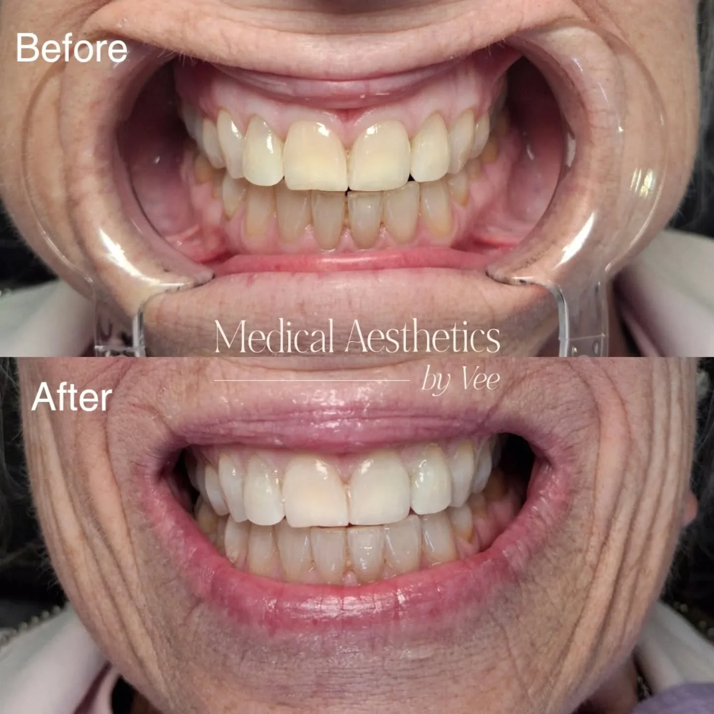 A brighter smile can make such a difference in your confidence!

It&rsquo;s nice to refresh your smile every so often, and this client achieved a noticeably brighter smile after just ONE cosmetic teeth whitening session! 

Whether you have an upcomin