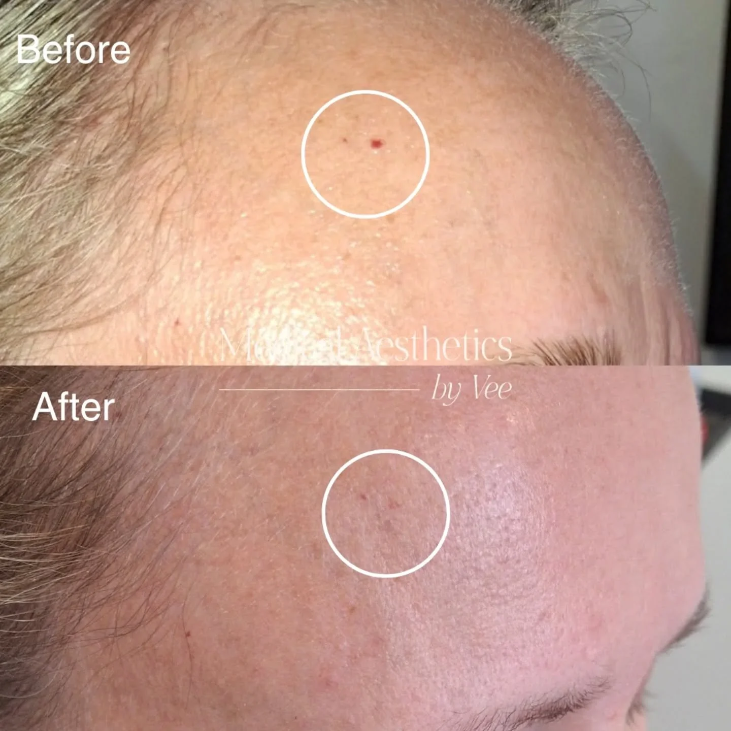 Intense Pulse Light (IPL)

This client presented with a small cherry angioma on her forehead and wanted it removed. After just 2 IPL treatments, we were able to significantly lighten the area, with a quick and simple 30-minute appointment.

IPL is an