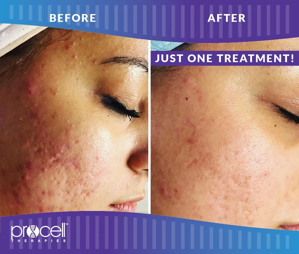 ProCellAcneScars_B_A_OneTreatment-002.JPG