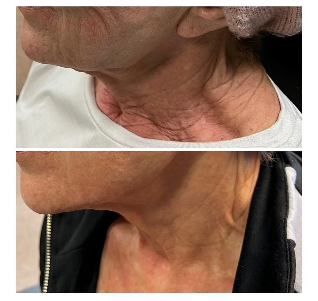 Jet-Plasma-Before-After-Picture-2.jpeg