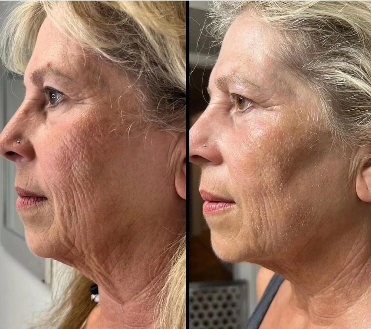 Jet-Plasma-Before-After-Picture-1.jpeg