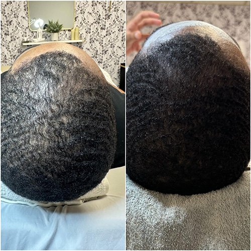 Discover Hydrafacial Keravive®: The Ultimate Scalp Treatment for Fuller, Healthier-Looking Hair at Beauty Skin Bar