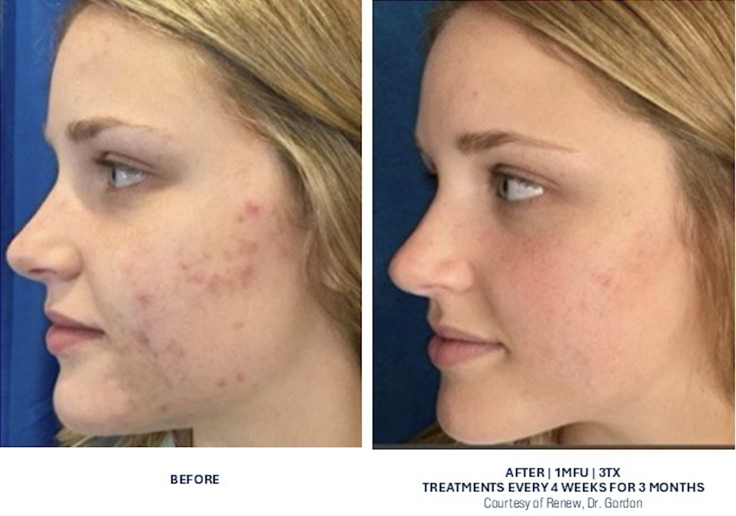 Glacial Skin Treatments in Fairfax, VA: Calm Redness, Clear Acne &amp; Restore Healthy Skin