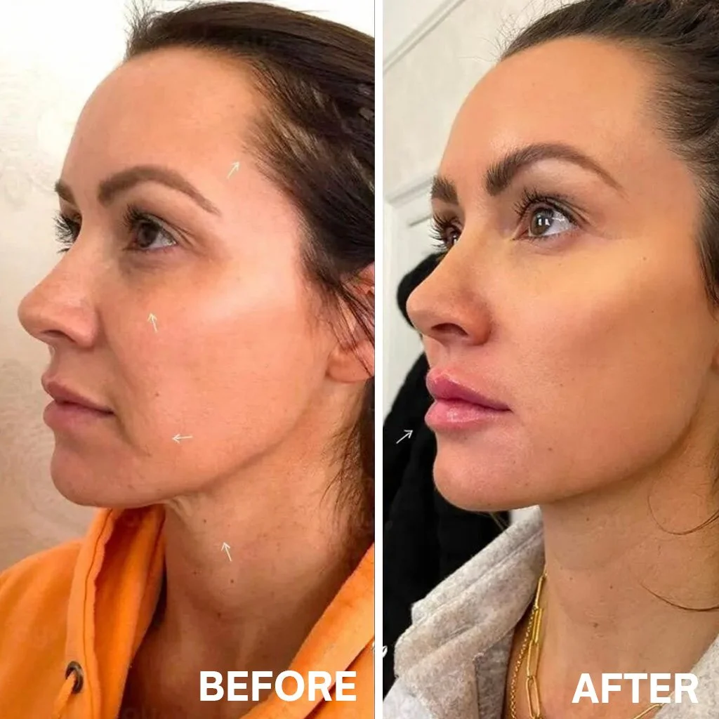 Fotona 4D Before After.jpg