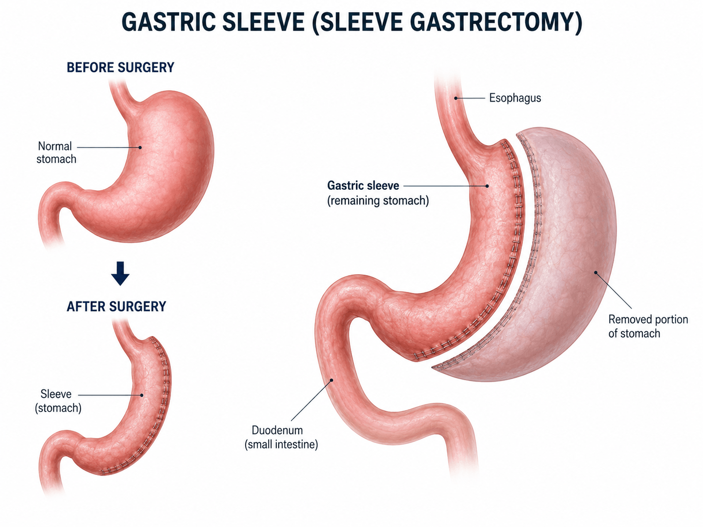 Diagram showing gastric sleeve surgery before and after removal of part of the stomach