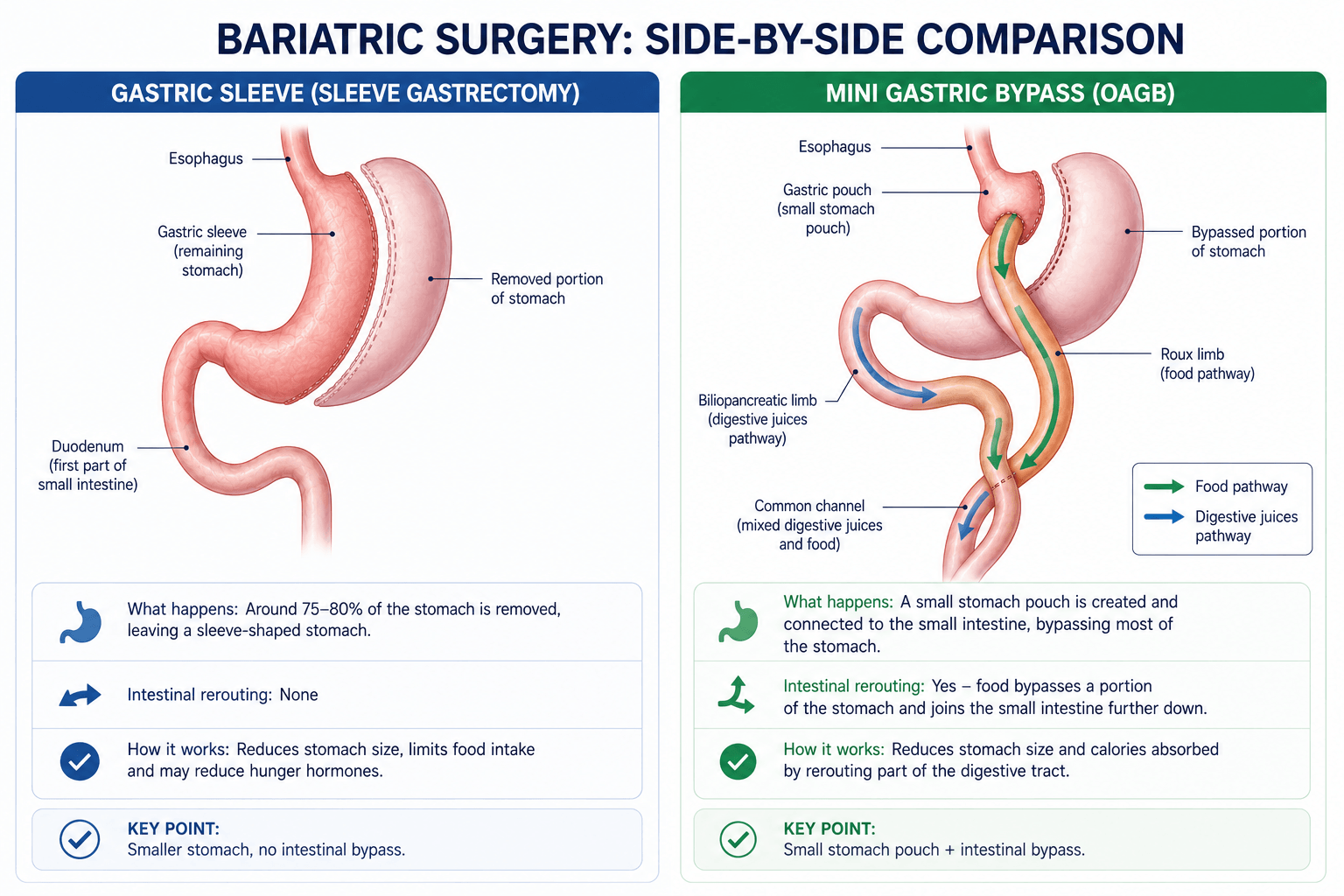 Side-by-side comparison of gastric sleeve and mini gastric bypass surgery showing stomach changes and intestinal rerouting