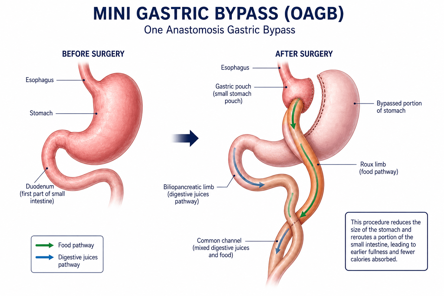 Diagram showing mini gastric bypass (OAGB) before and after surgery with the stomach pouch and rerouted small intestine