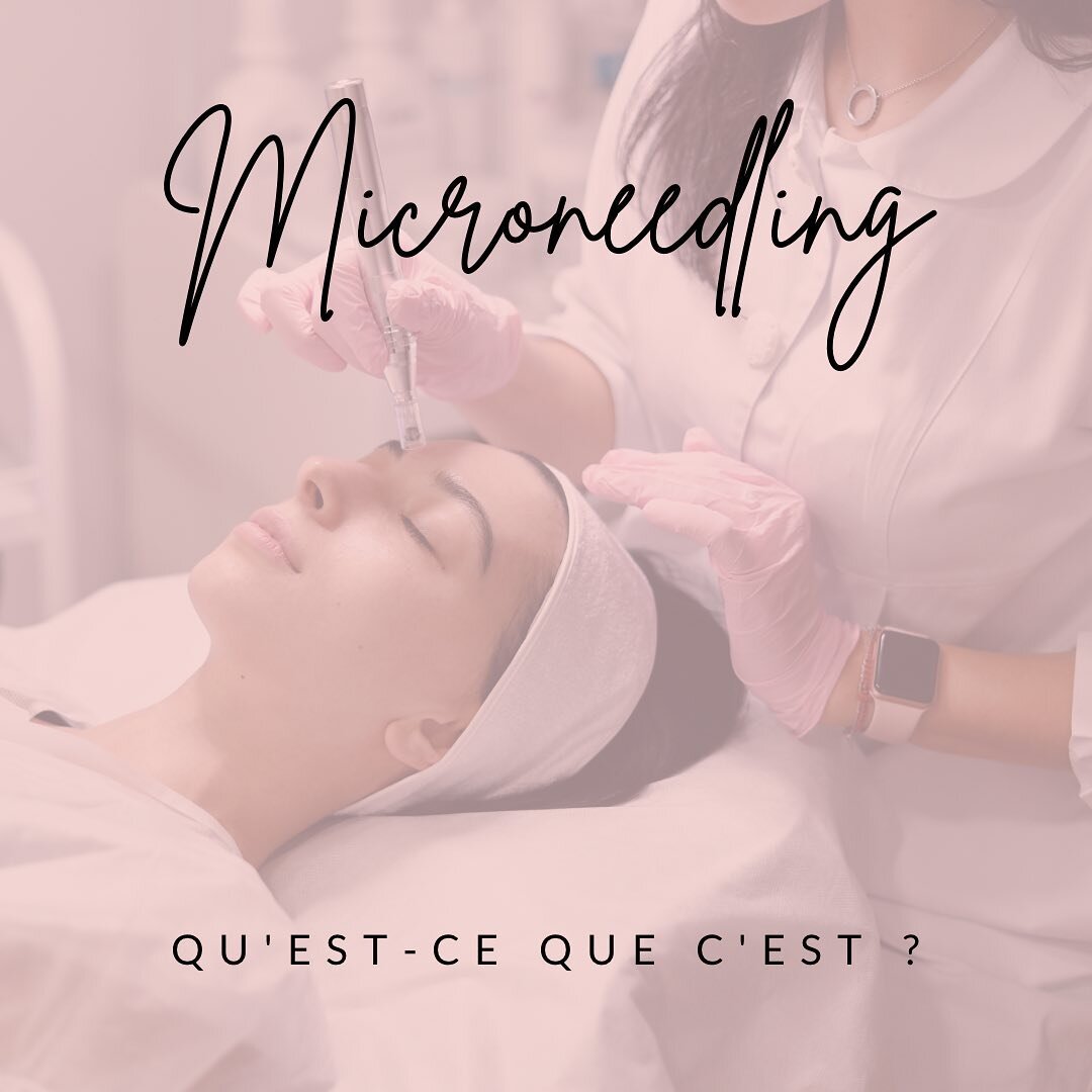 La technique du microneedling consiste &agrave; r&eacute;aliser dans une zone cibl&eacute;e de la peau, des micro-perforations &agrave; l&rsquo;aide d&rsquo;un appareil ressemblant &agrave; un stylo &eacute;lectrique.

Ces micro-perforations sont eff