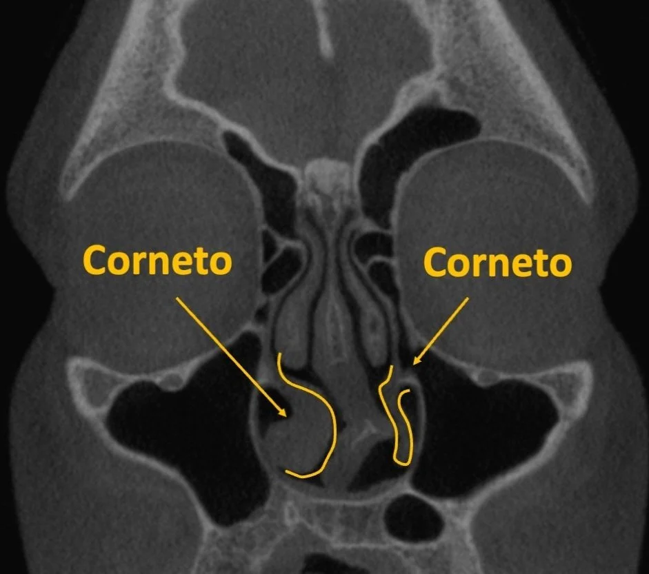 Cornetos Nasais Inchados Sintomas - RETOEDU