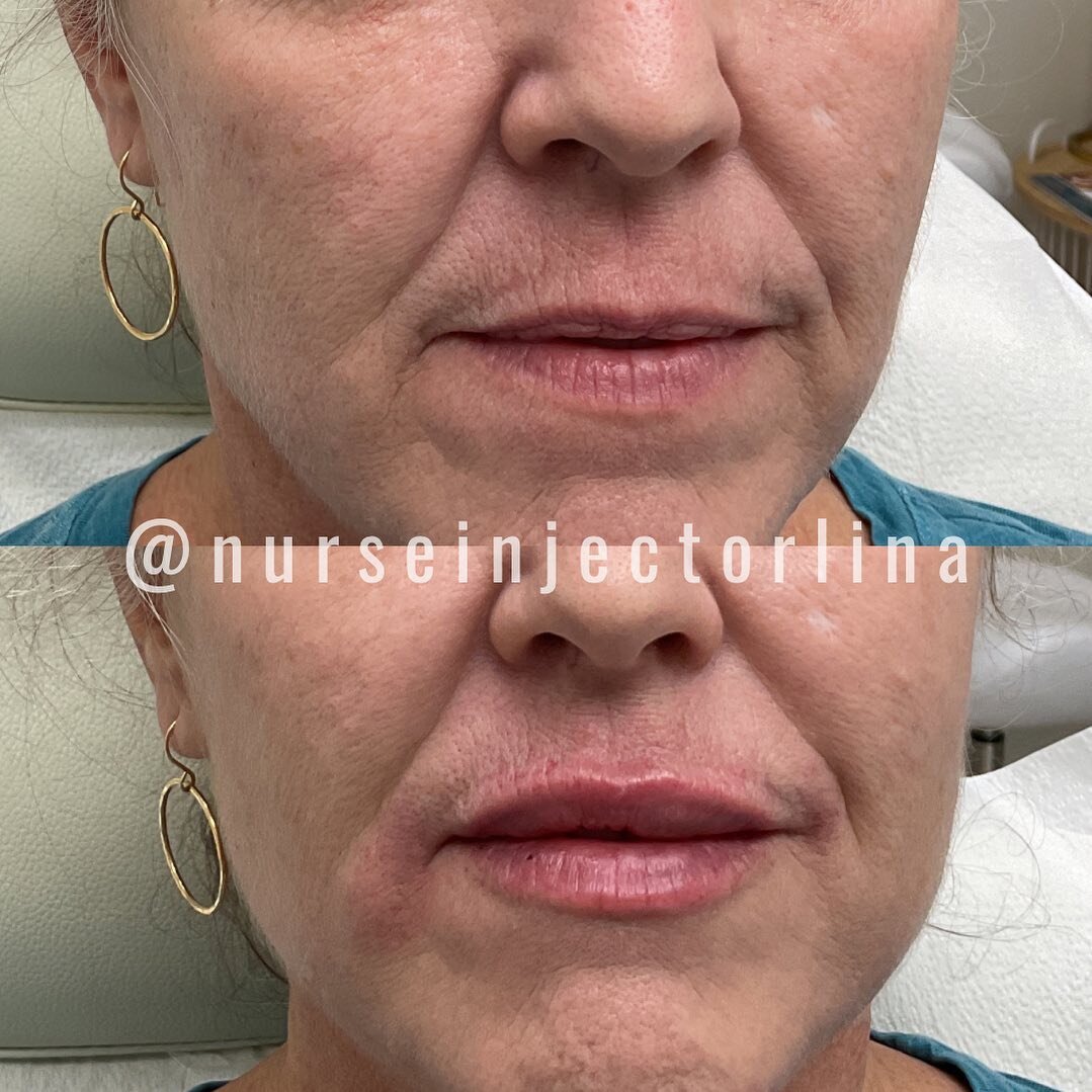 Plump your smoocher with a half syringe for just $400. This month only!!! Book your appointment using the link in my bio ✨

#skinmedexkauai #kauaimedspa #lipfiller #kauai