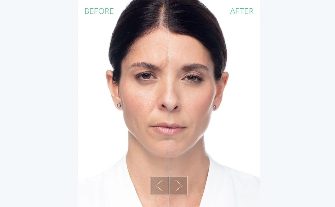 Neuromodulators Before and After 5.jpg