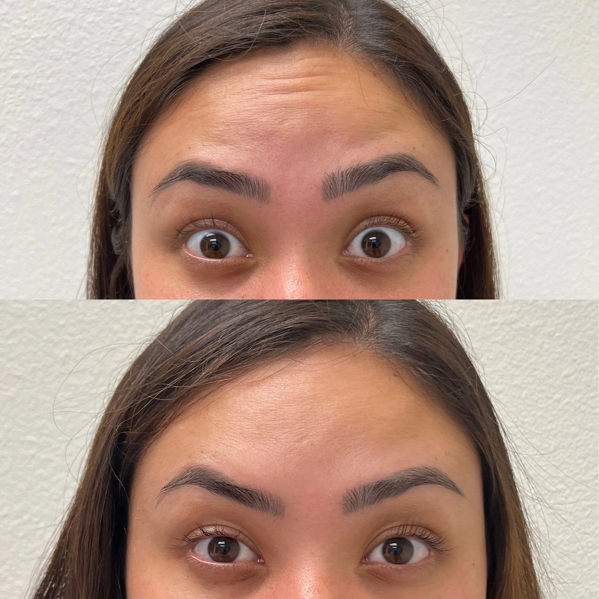 Skin Medex | Neurotoxin Before and After.JPG