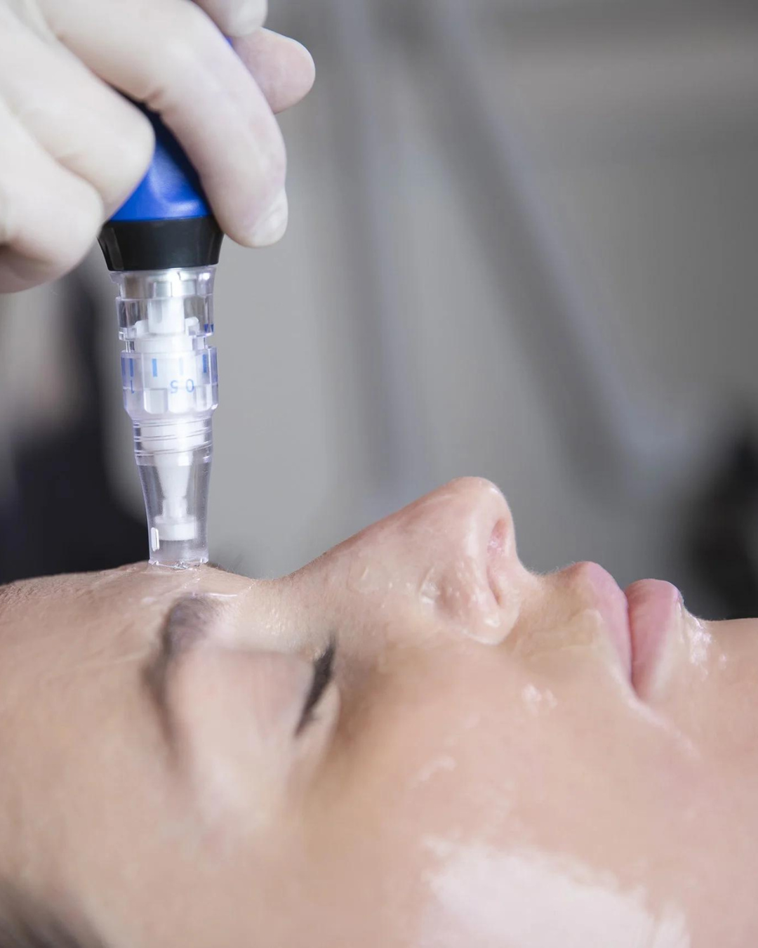 When Should You Book Your Next Microneedling Appointment?