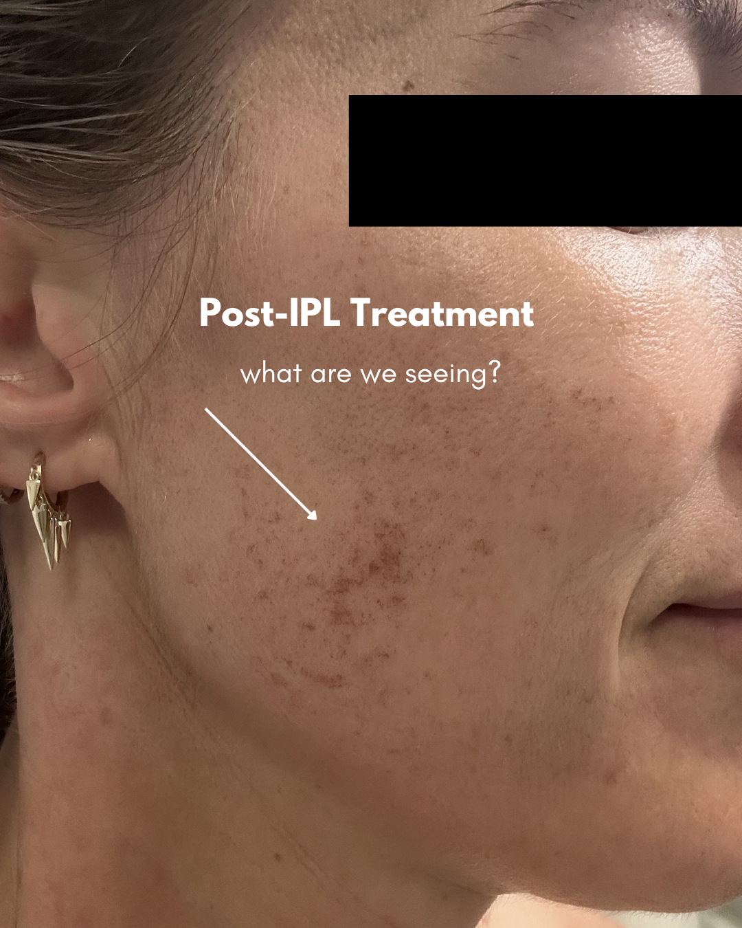 IPL Photofacials: The Treatment People Notice… But Can’t Always Explain