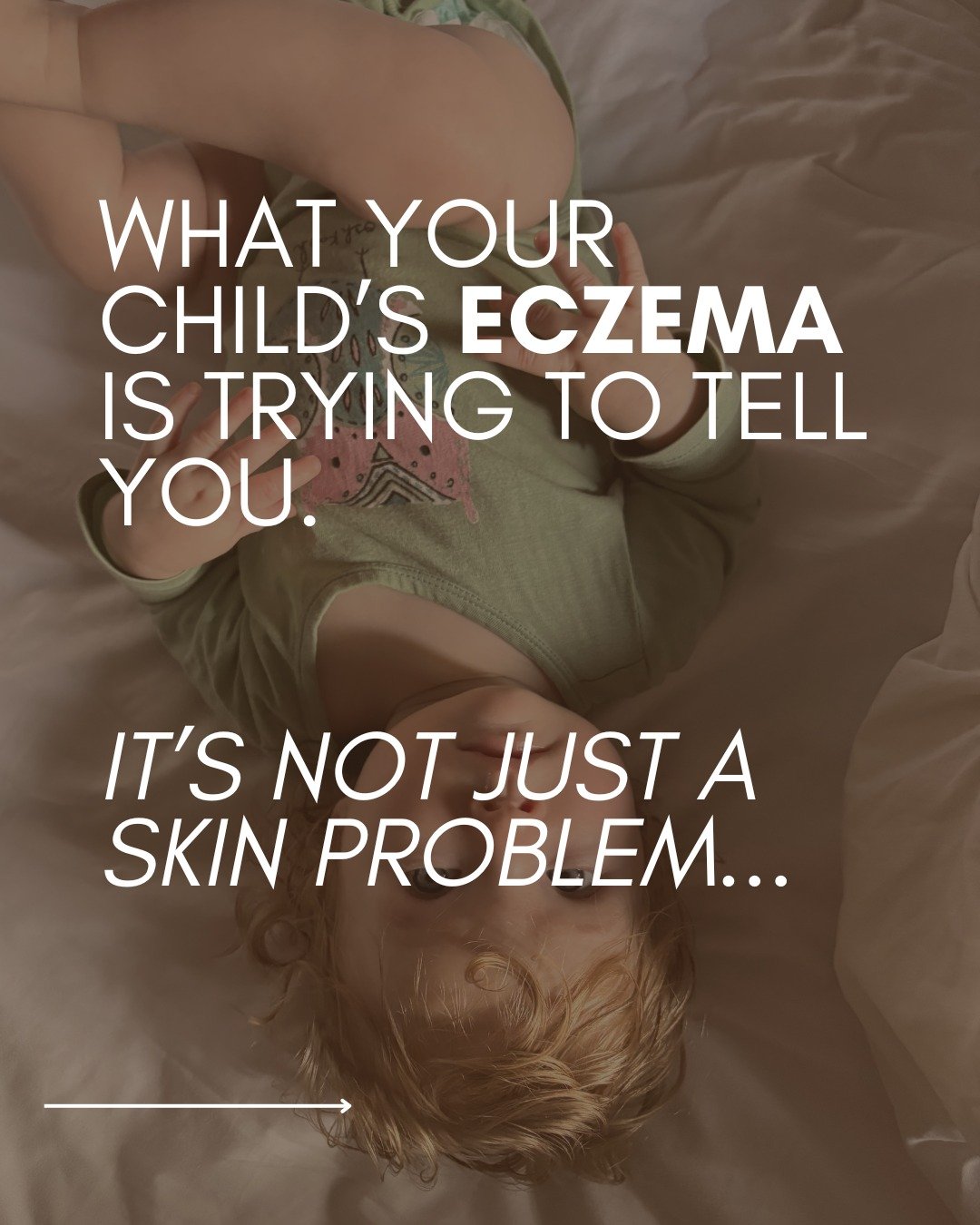 Eczema isn&rsquo;t just a skin condition.

In many cases, it reflects what&rsquo;s happening internally, including gut health, immune function, and the nervous system.

These systems are closely connected.

When gut integrity is compromised, immune r