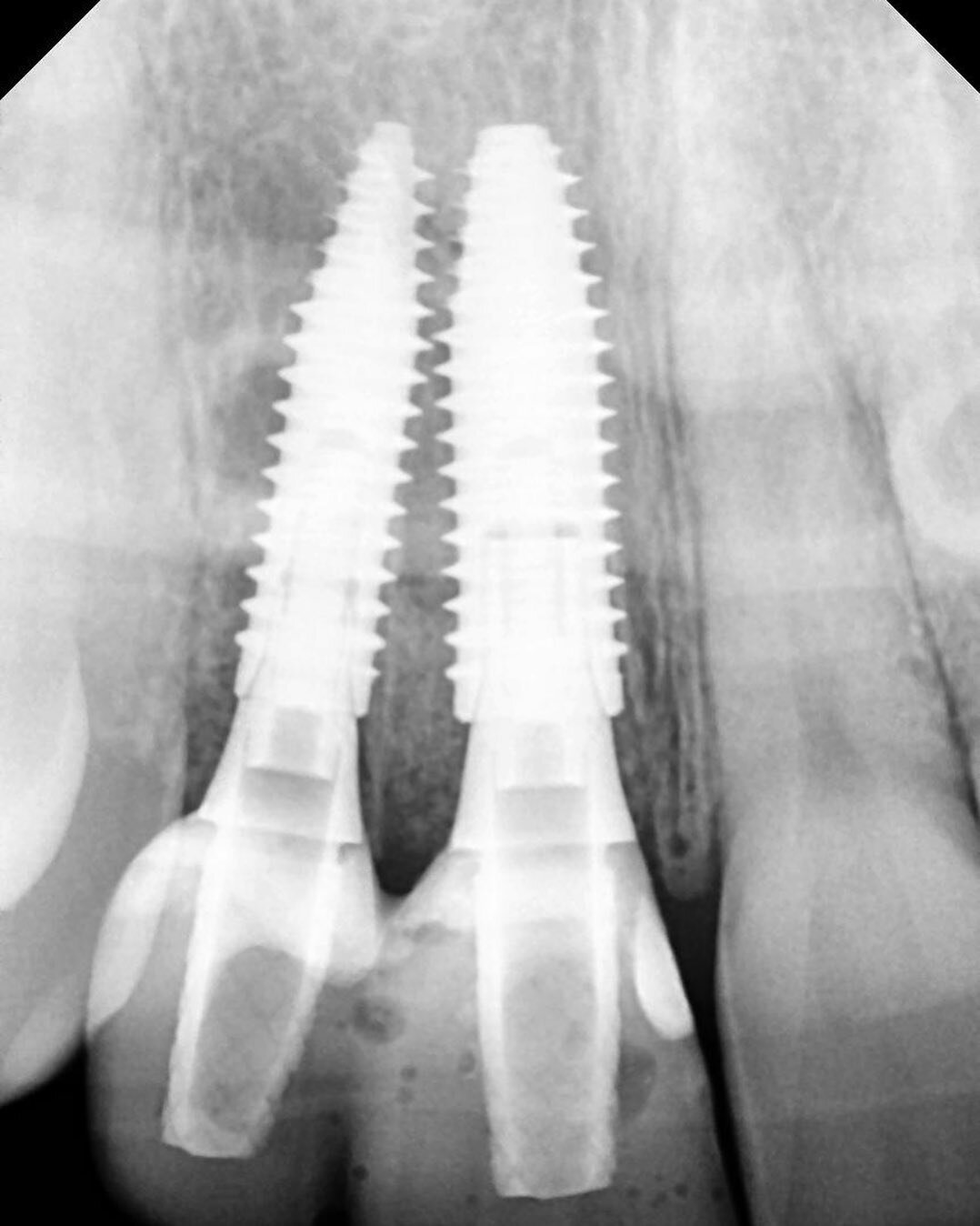 Good thing those are implants and not natural roots. 😂. 

Jokes aside, the implant positions were driven by restorative positions, shape, and angulations of the final restorations.  The emergence profile is the key factor in Implant depth, angulatio