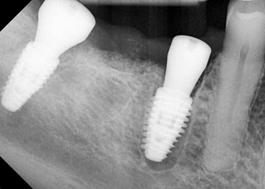 Both immediates.  Used deep threaded implant from @megagen_canada for the premolar. This was a &ldquo;no-drill&rdquo; immediate for the premolar.  Molar immediate was harder due to tilting of the natural roots.  Swipe to see the pre-op and 4 months p