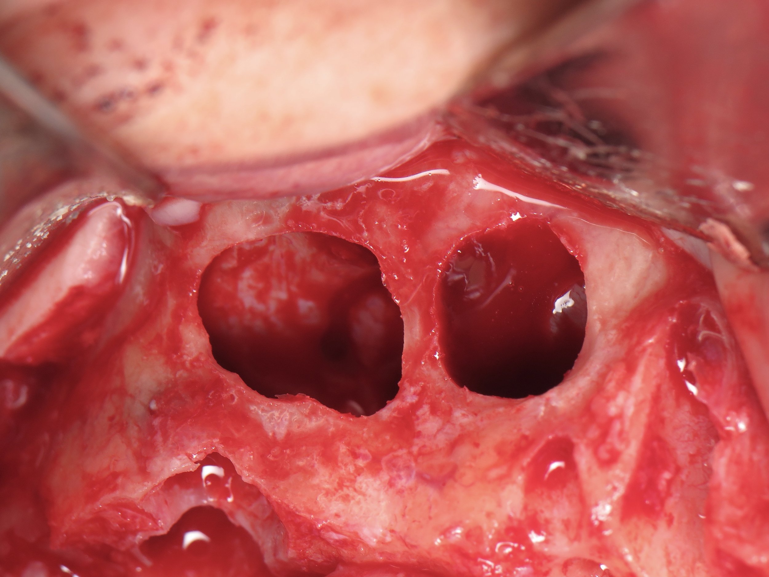 lateral sinus.jpg