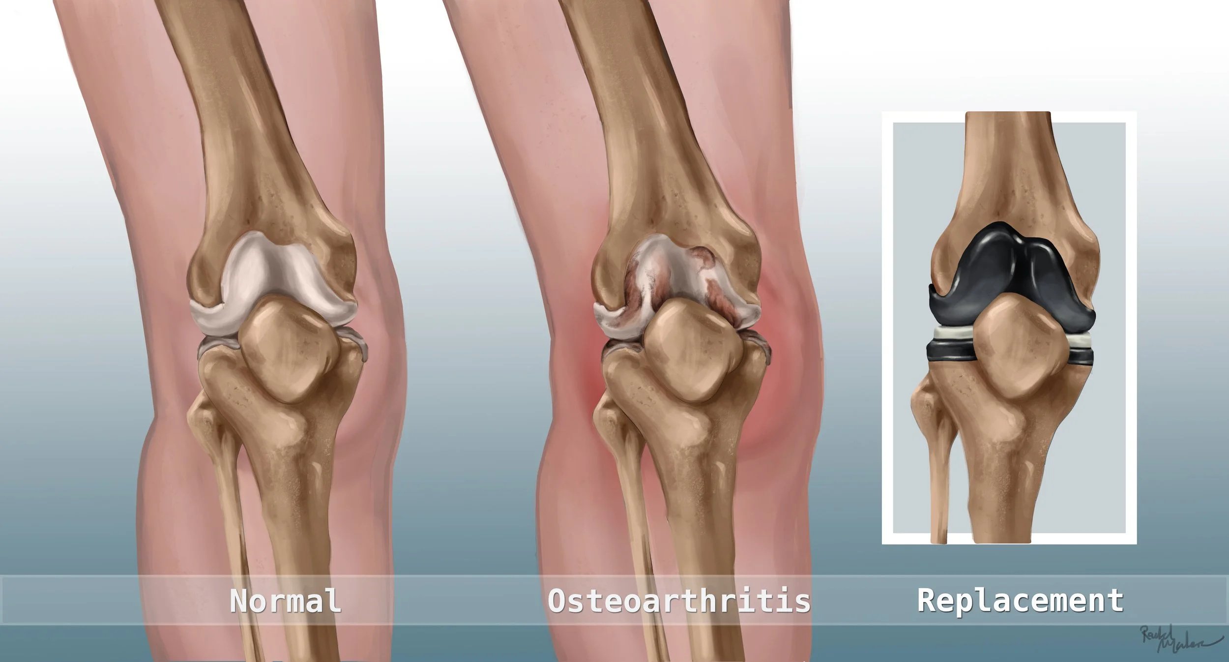 Finalknee.jpg