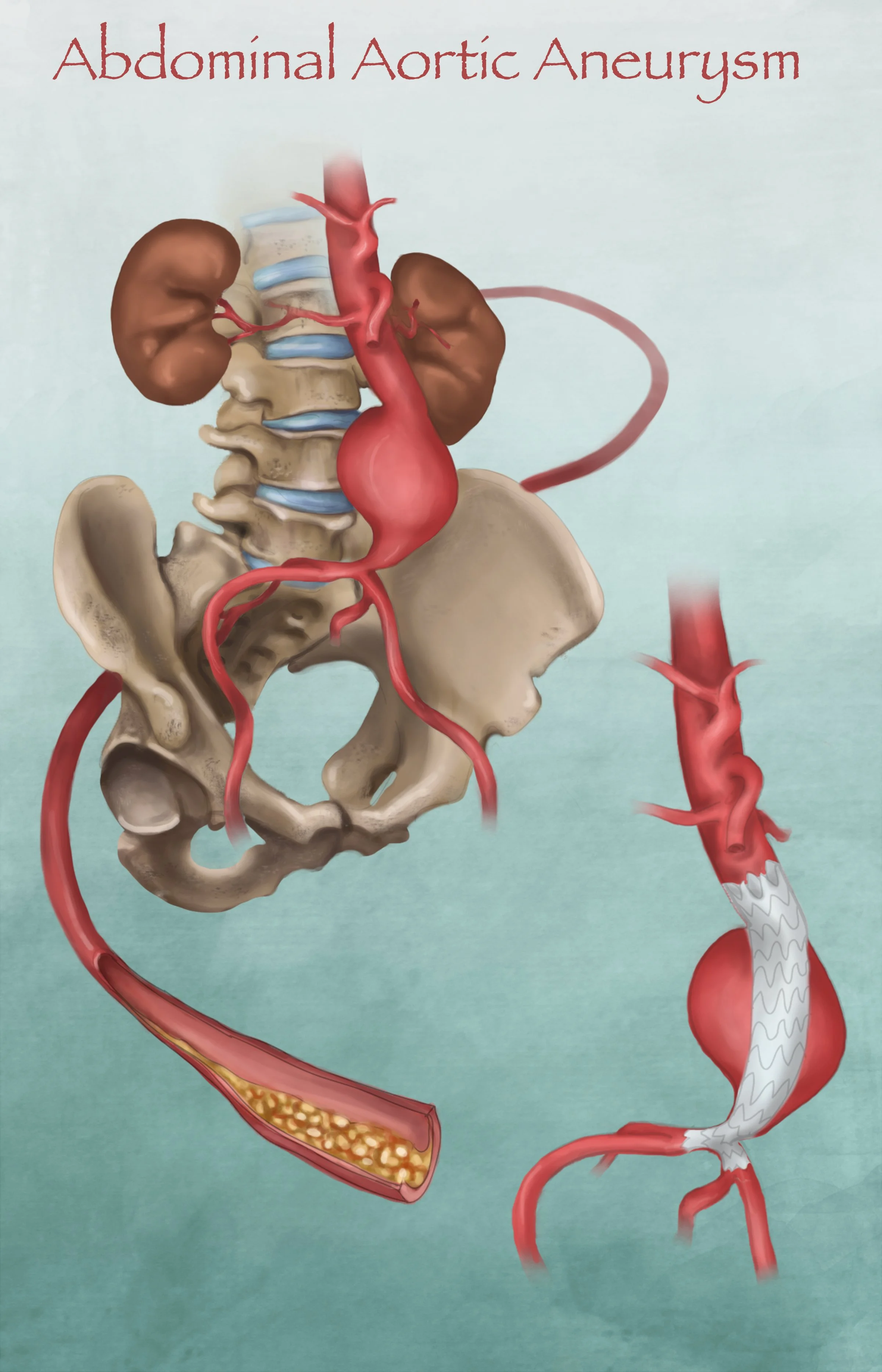 AORTaremake.jpg