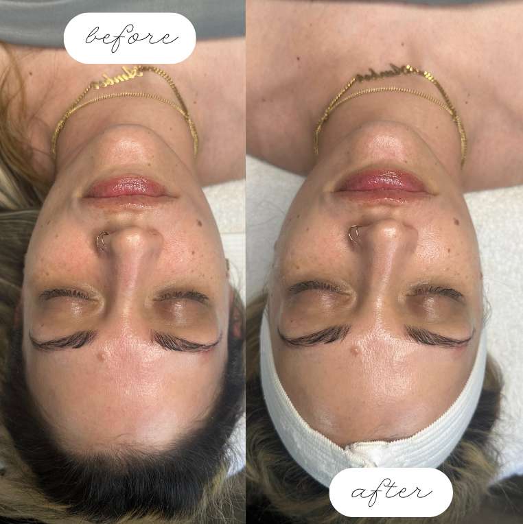 before and after facial at Elite Aesthetics Academy.PNG