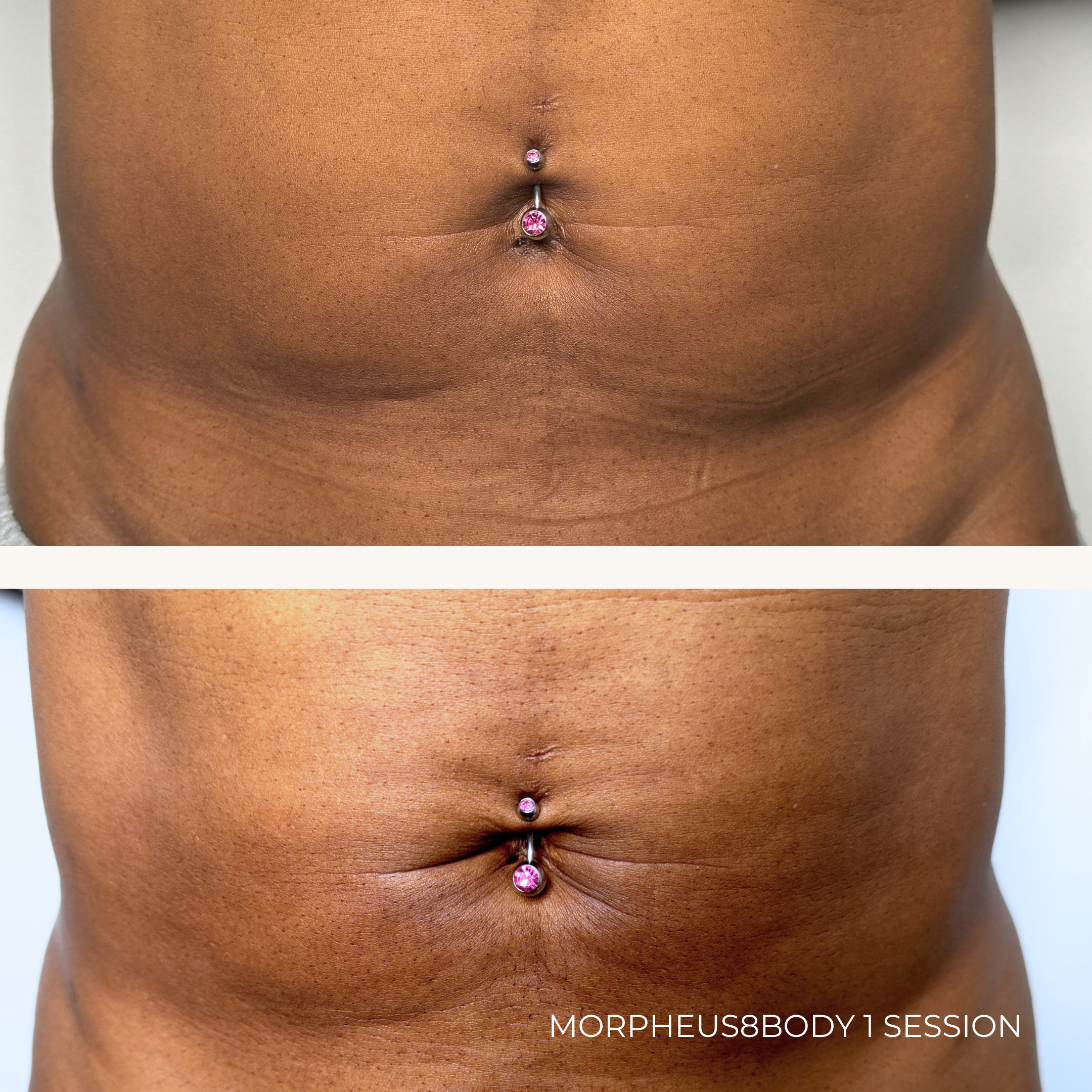 Morphneus8 Body Denver Medspa.PNG