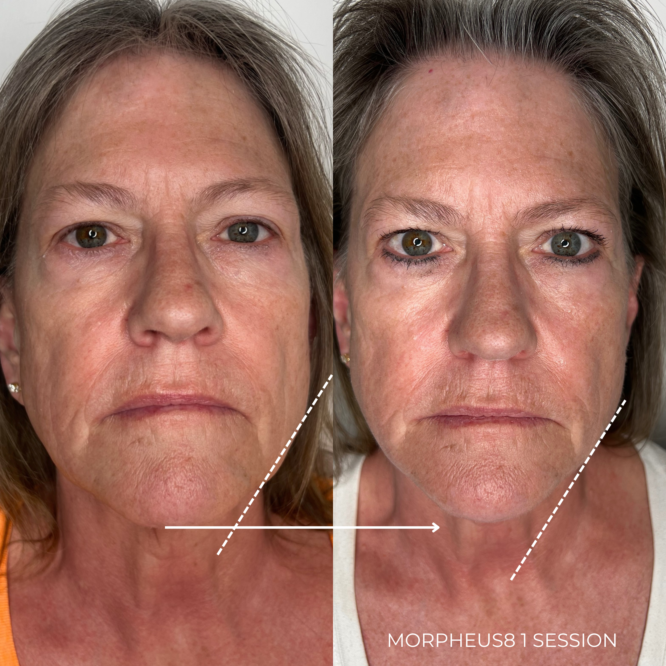 Before and after Morphues8 face and neck results.PNG