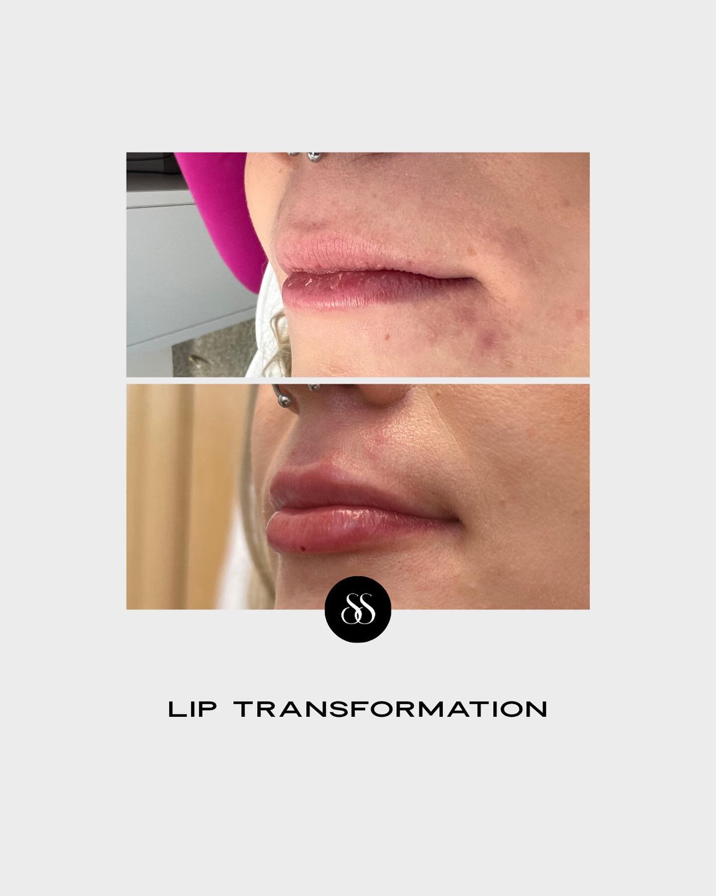 Lip Transformations at Skin Suite with @skinsuitewpg.lauren 

To book your filler appointment or consultation, book online or call. 

📱 Link in Profile to Book Online 
📧 info@skinsuitewpg.com
📞 (204) 505 7546

#skinsuitewinnipeg #skinsuitewpg #lip