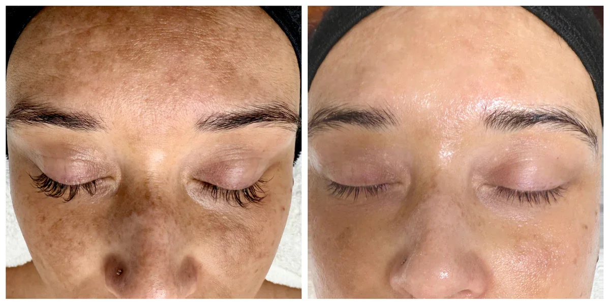 Melasma vs Hyperpigmentation — What’s Actually Happening to Your Skin?