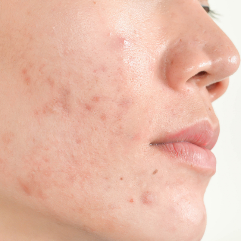 Acne &amp; Pigmentation — Why Breakouts Leave Marks (and How to Fix It)