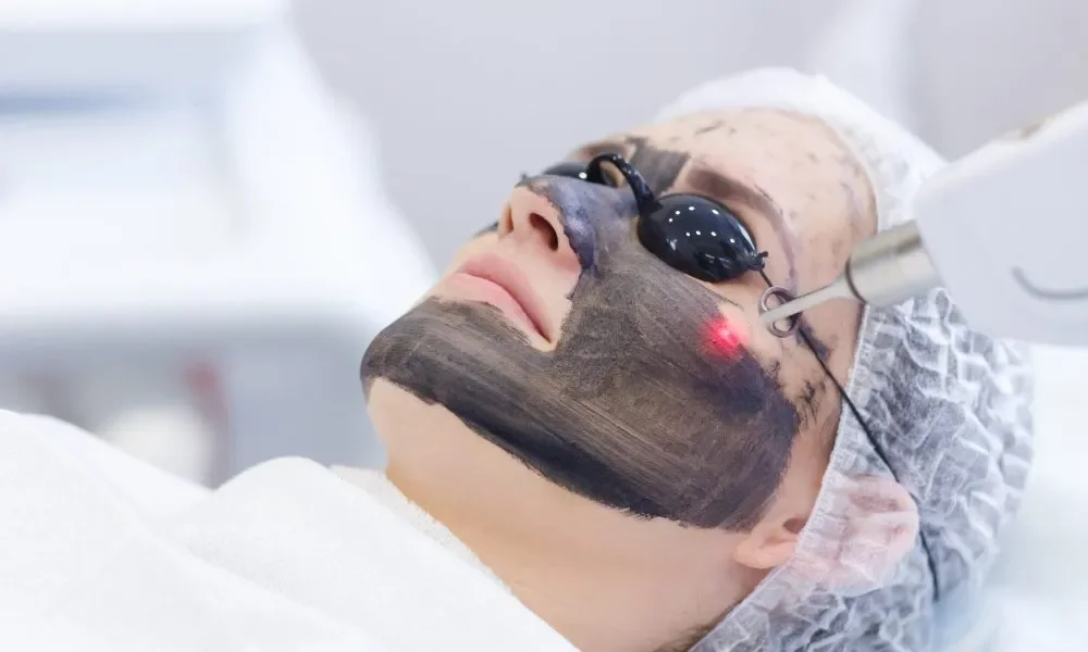 What is a Carbon Facial? The “Hollywood Facial” Explained